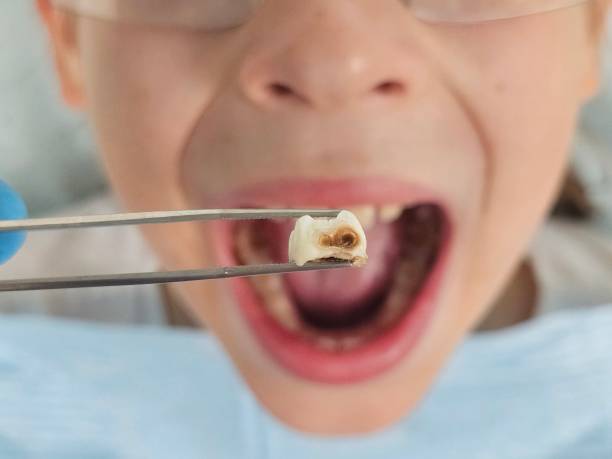 Best Emergency Root Canal Treatment in Topeka, KS